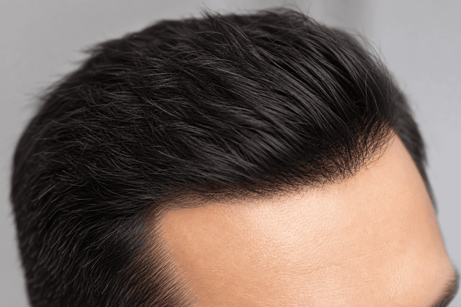 FUE Hair Transplant illustration